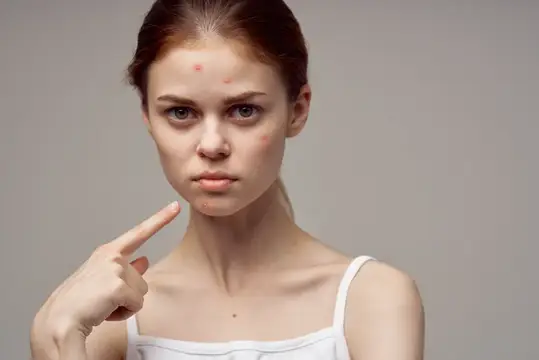 Женщина с чистой кожей, что указывает на проблемы с акне и здоровьем кожи, а также дерматологию