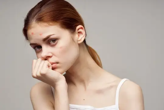Рыжеволосая женщина с прыщами на лице, гигиена на изолированном фоне