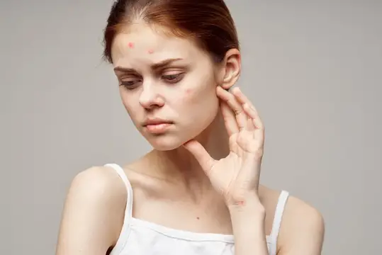 Женское лицо, проблема с кожей, акне, портрет, обрезанный вид