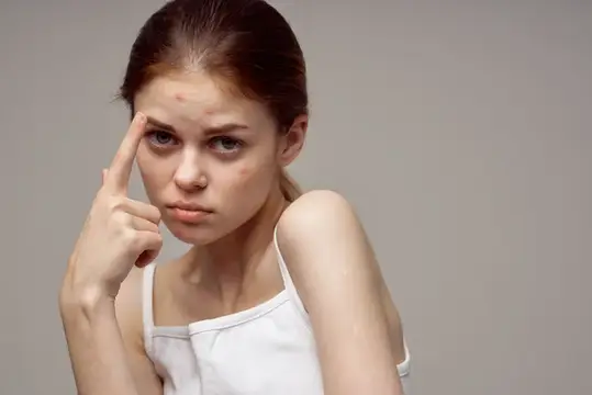 Молодая девушка с прыщом на лбу указывает на него пальцем