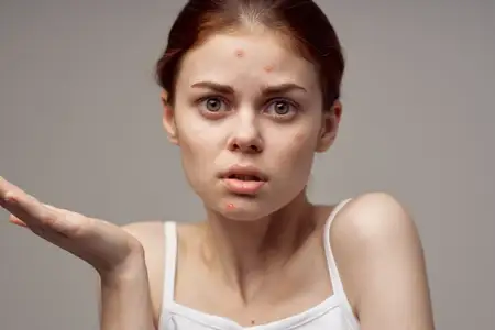 Красивая женщина в белой футболке, на лице видны прыщики, на светлом фоне