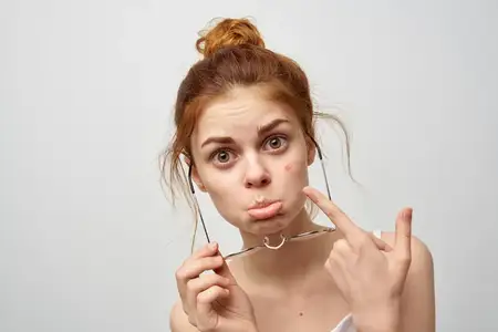 Женщина в белой футболке, в очках, с прыщами на лице