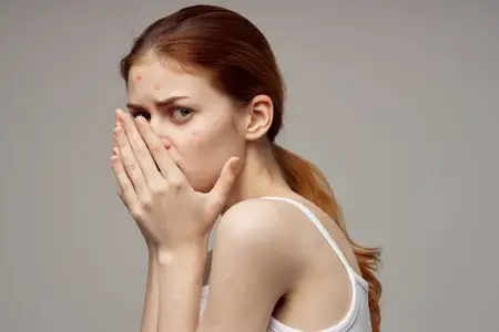 Женщина с прыщом на лице прикасается руками к лицу, что указывает на проблемы со здоровьем и акне